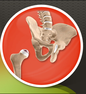 Anterior Hip Replacement Dallas